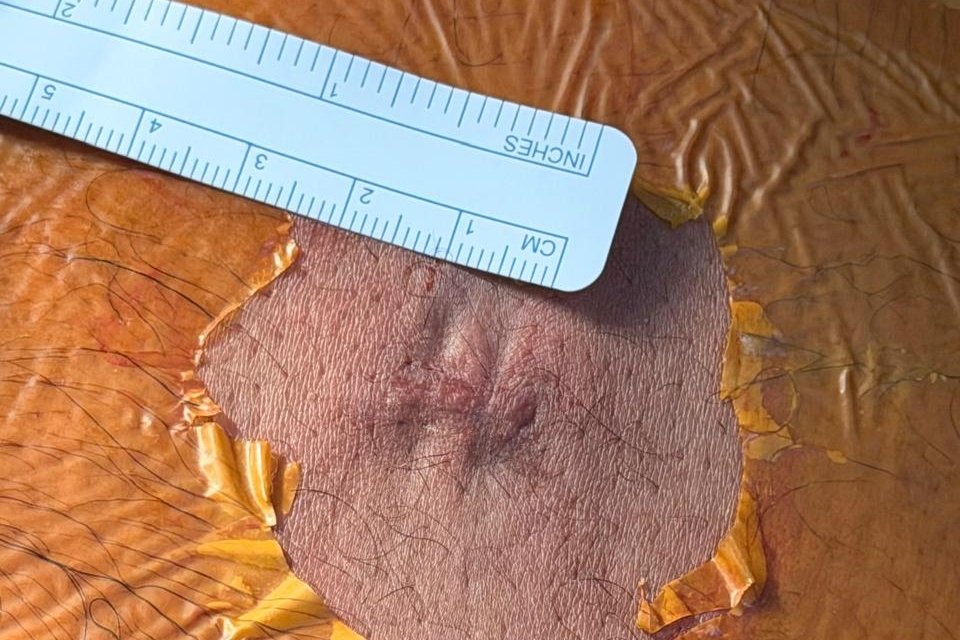 Small minimally invasive surgery scar